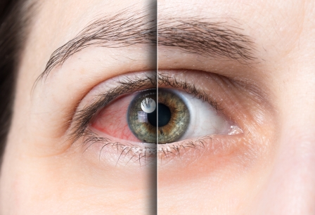 Покраснение глаз — что это? Причины и как лечить красные глаза | Visiobud